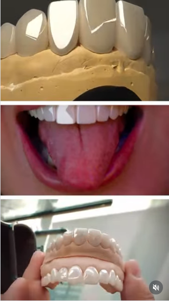 Эстетическая реставрация — AK STOM